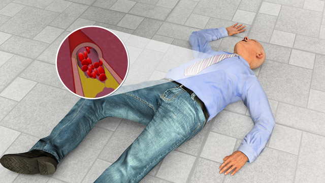 First Aid - Heart Attacks and Cardiac Arrest